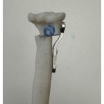 Polyaxial TPLO T-support plate, new version